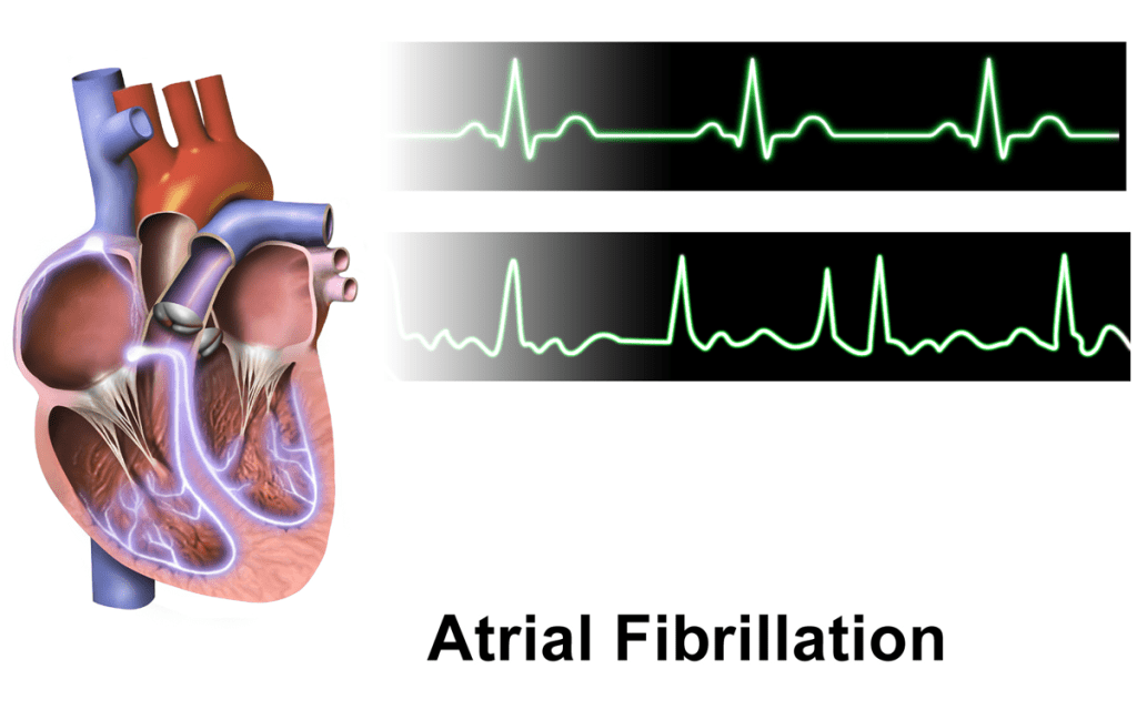 Atrial Fibrillation In African Americans