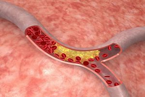 Is Cholesterol Lowering Medicine Bad for You?
