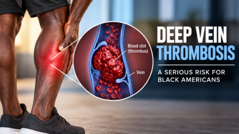 Deep vein thrombosis warning graphic — blood clots are a higher risk for Black patients in the hospital and during cancer treatment