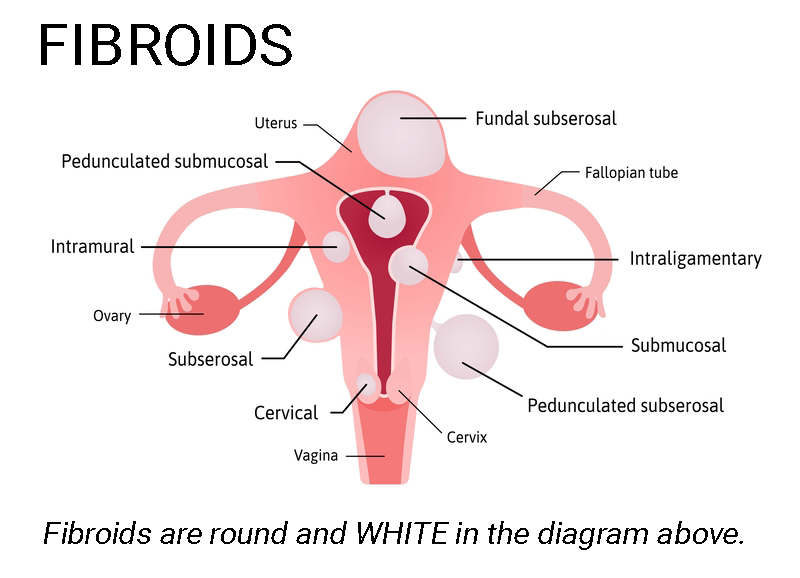 Fibroids and African American women