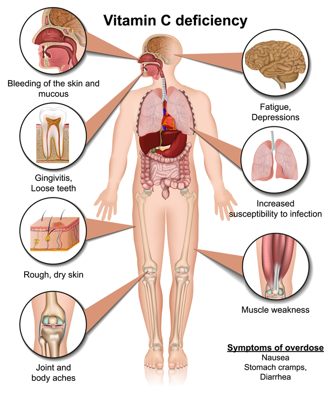 Vitamin C Deficiency in African Americans