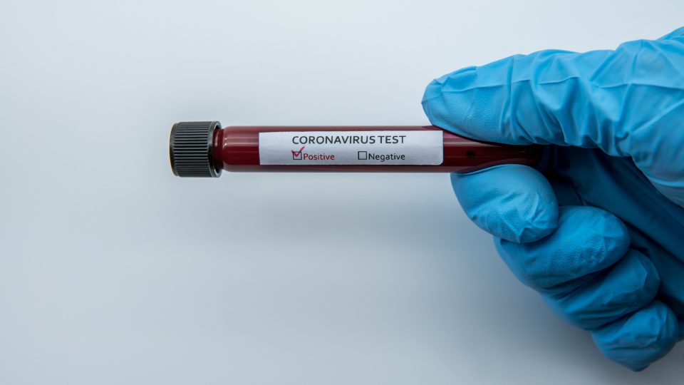 Positive COVID-19 test and laboratory sample blood testing for diagnosis